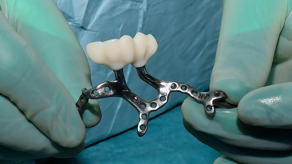 Närbild på gummihandskklädda fingrar som håller upp en käkprotes i titan. Den ser ut som en metallremsa med hål, nästan som gammeldags mekano. I änden syns två skruvar som håller en tandprotes med 4-5 tänder.