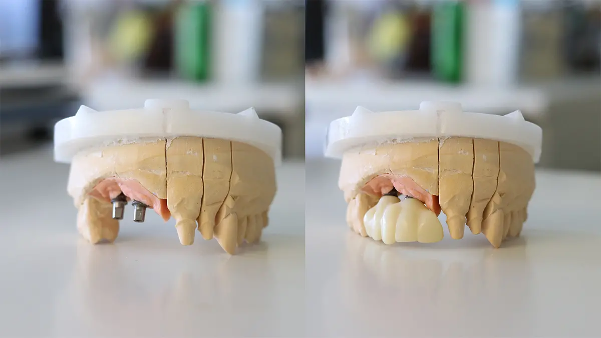 Konstgjord form av tandkött och tänder. Framtill på ena bilden saknas tänder och två skruvar sticker ut ur tandköttet. På andra bilden syns det hur en tandrad med 4-5 tänder fästs i dessa skruvar och gör munnen komplett.